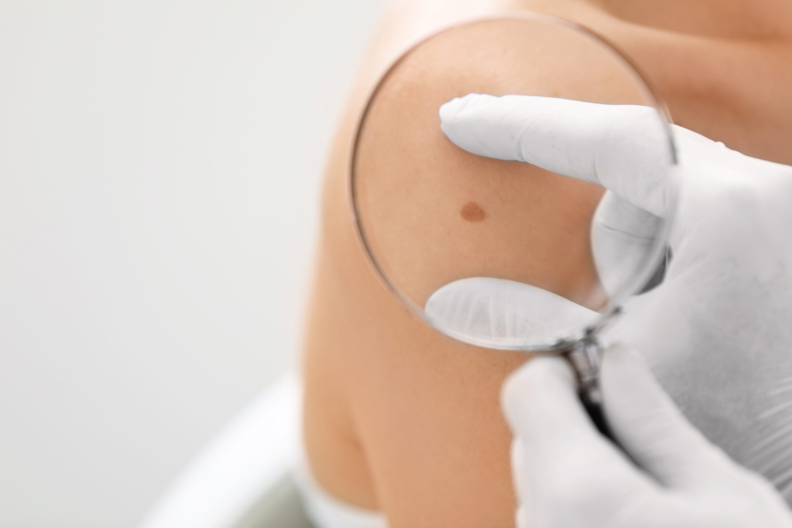 Skin Cancer and Sun Protection